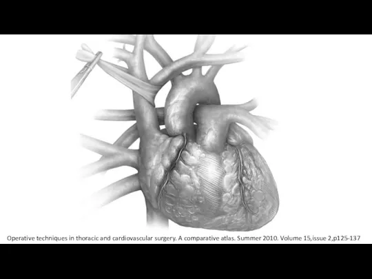 Operative techniques in thoracic and cardiovascular surgery. A comparative atlas. Summer 2010. Volume 15,issue 2,p125-137