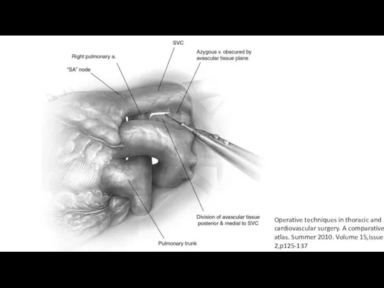 Operative techniques in thoracic and cardiovascular surgery. A comparative atlas. Summer 2010. Volume 15,issue 2,p125-137