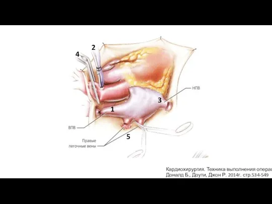 Кардиохирургия. Техника выполнения операций Доналд Б., Доути, Джон Р. 2014г. стр.534-549 1 2 3 4 5