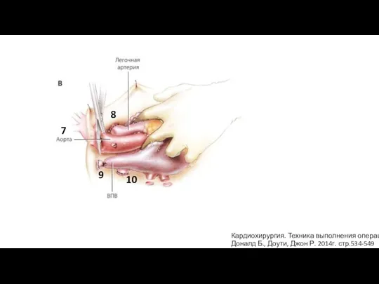 Кардиохирургия. Техника выполнения операций Доналд Б., Доути, Джон Р. 2014г. стр.534-549 7 8 9 10