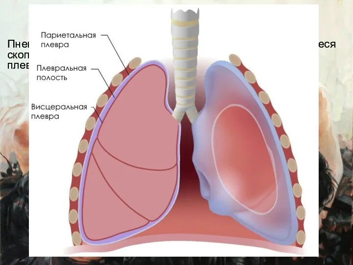 Пневматоракс Пневмоторакс— патологическое состояние, характеризующееся скоплением воздуха между висцеральной и париетальной плеврой.