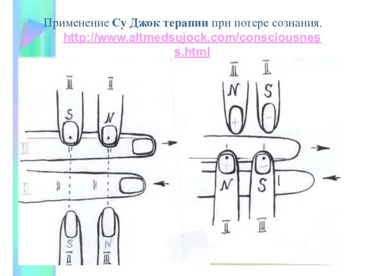 Применение Су Джок терапии при потере сознания. http://www.altmedsujock.com/consciousness.html