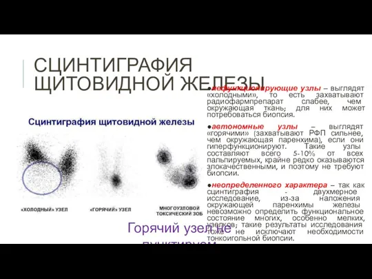 СЦИНТИГРАФИЯ ЩИТОВИДНОЙ ЖЕЛЕЗЫ ●нефункционирующие узлы – выглядят «холодными», то есть захватывают радиофармпрепарат