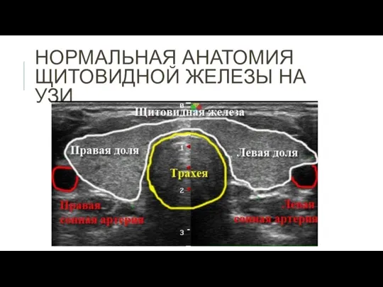 НОРМАЛЬНАЯ АНАТОМИЯ ЩИТОВИДНОЙ ЖЕЛЕЗЫ НА УЗИ