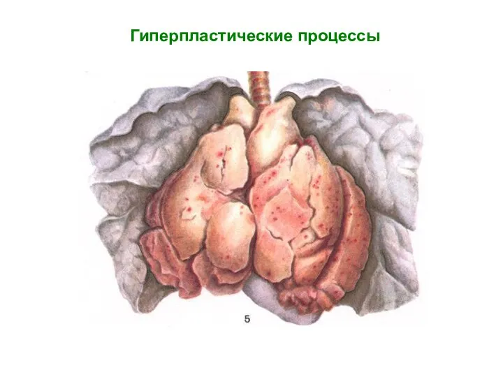 Гиперпластические процессы