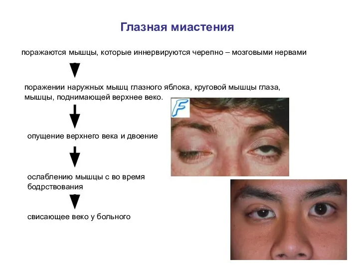 Глазная миастения поражаются мышцы, которые иннервируются черепно – мозговыми нервами поражении наружных