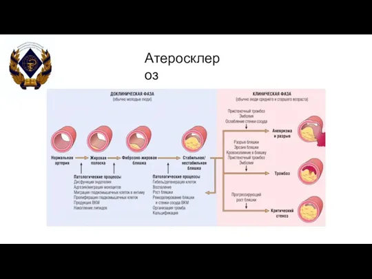 Атеросклероз