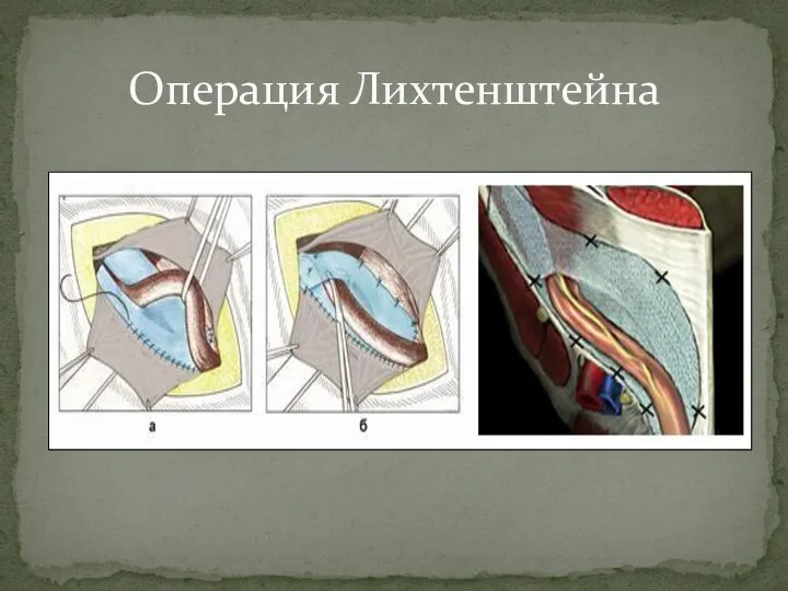 Операция Лихтенштейна