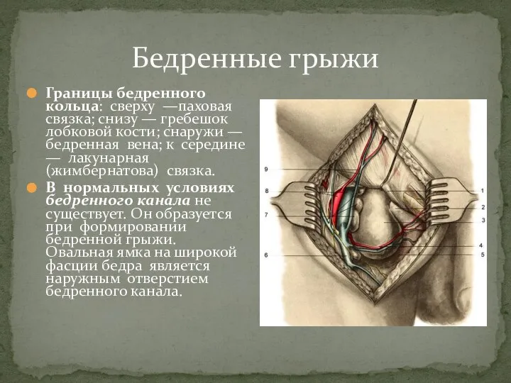 Бедренные грыжи Границы бедренного кольца: сверху —паховая связка; снизу — гребешок лобковой