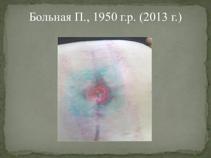 Больная П., 1950 г.р. (2013 г.)