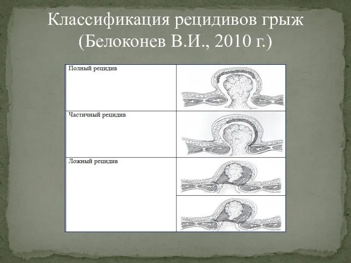 Классификация рецидивов грыж (Белоконев В.И., 2010 г.)