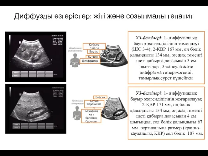 Диффузды өзгерістер: жіті және созылмалы гепатит Қабыну ошағы Бүйрек Бауыр Диафрагма УЗ-белгілері: