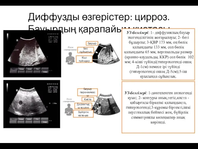 Диффузды өзгерістер: цирроз. Бауырдың қарапайым кистасы Бауыр Бос сұйықтық Кіші түйіндер УЗ-белгілері: