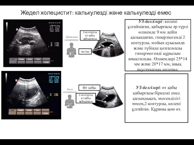 Жедел холецистит: калькулезді және калькулезді емес УЗ-белгілері: көлемі ұлғаймаған, қабырғасы әр түрлі