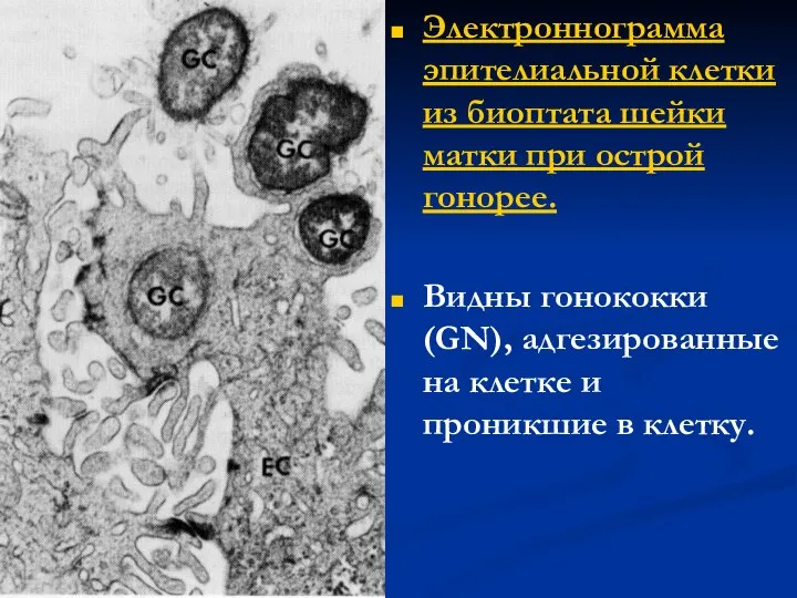 Электроннограмма эпителиальной клетки из биоптата шейки матки при острой гонорее. Видны гонококки