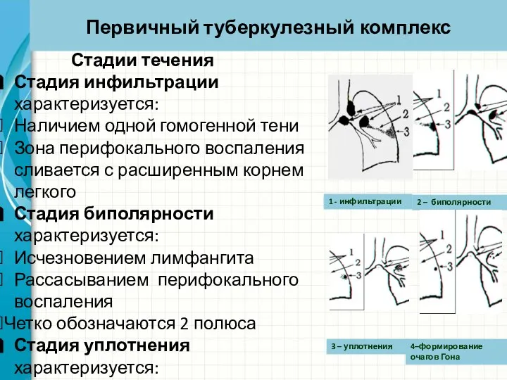 Первичный туберкулезный комплекс Стадии течения Стадия инфильтрации характеризуется: Наличием одной гомогенной тени