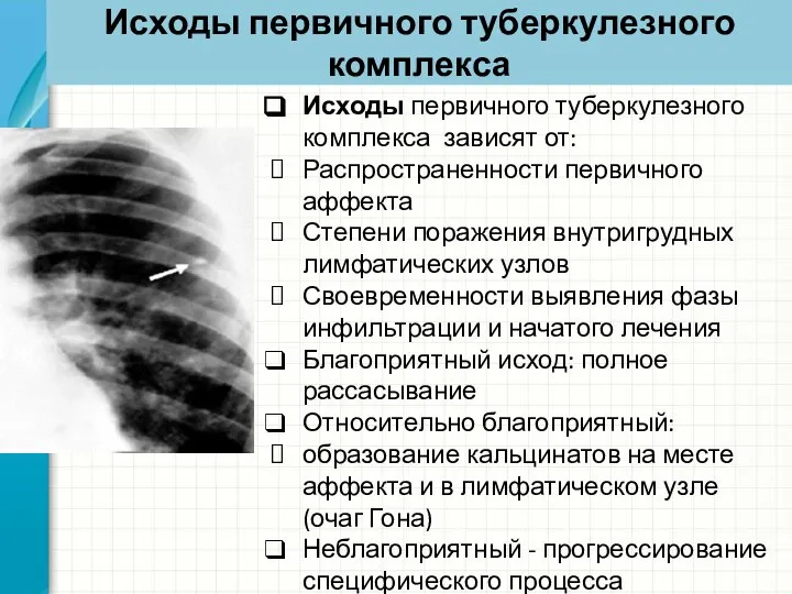 Исходы первичного туберкулезного комплекса Исходы первичного туберкулезного комплекса зависят от: Распространенности первичного