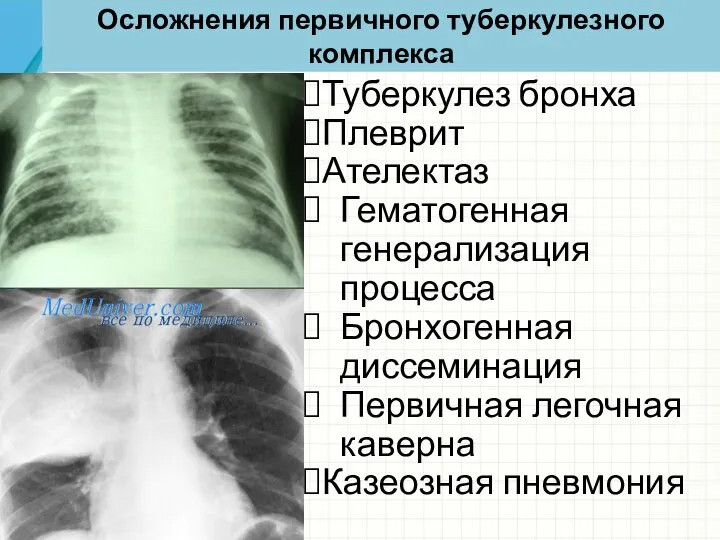 Осложнения первичного туберкулезного комплекса Туберкулез бронха Плеврит Ателектаз Гематогенная генерализация процесса Бронхогенная