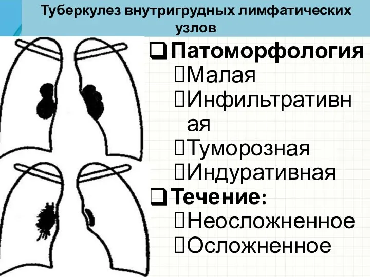 Туберкулез внутригрудных лимфатических узлов Патоморфология Малая Инфильтративная Туморозная Индуративная Течение: Неосложненное Осложненное