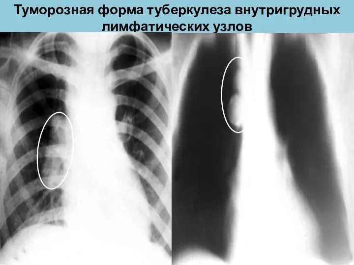 Туморозная форма туберкулеза внутригрудных лимфатических узлов