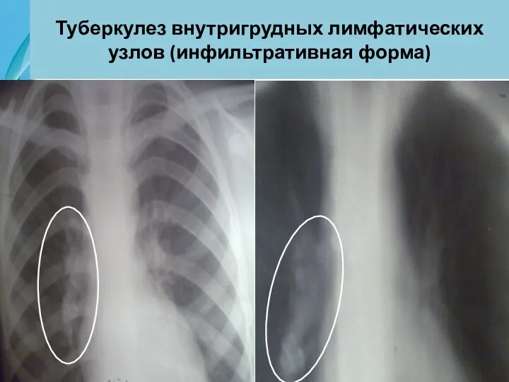 Туберкулез внутригрудных лимфатических узлов (инфильтративная форма)