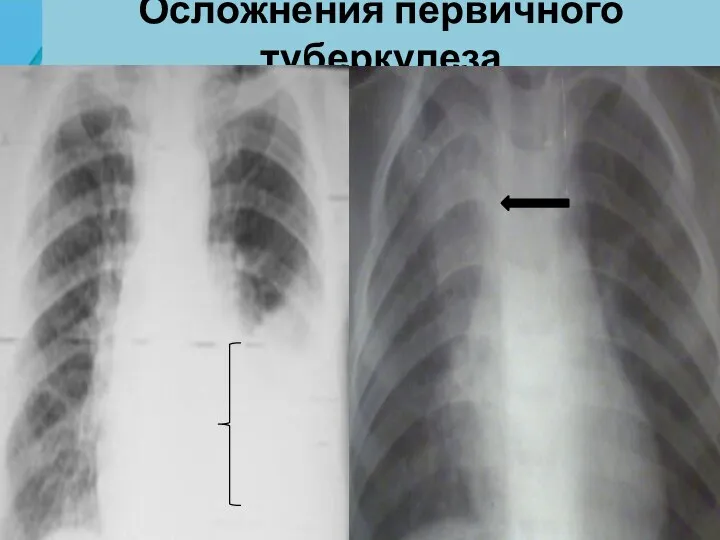 Осложнения первичного туберкулеза