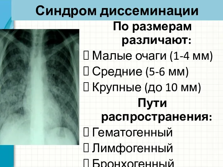 Синдром диссеминации По размерам различают: Малые очаги (1-4 мм) Средние (5-6 мм)