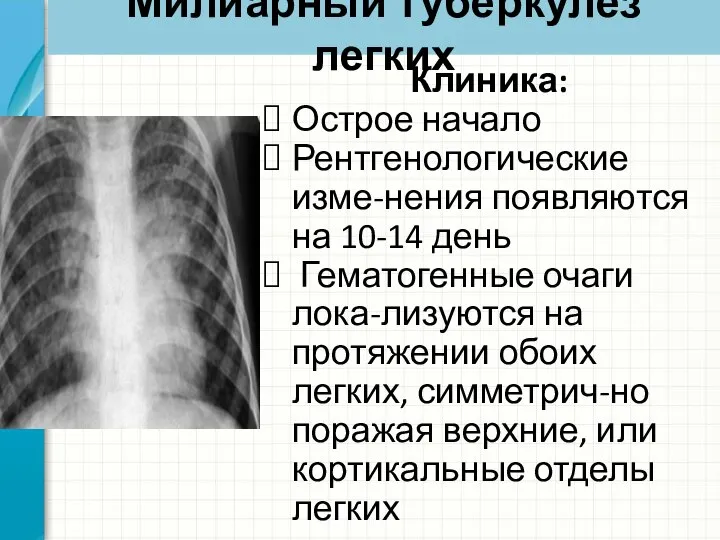 Милиарный туберкулез легких Клиника: Острое начало Рентгенологические изме-нения появляются на 10-14 день