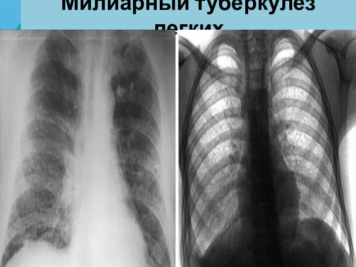 Милиарный туберкулез легких