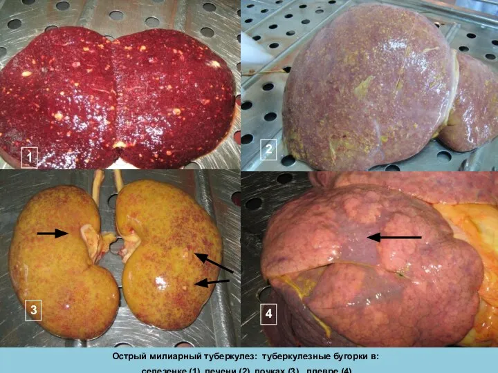 Острый милиарный туберкулез: туберкулезные бугорки в: селезенке (1), печени (2), почках (3),