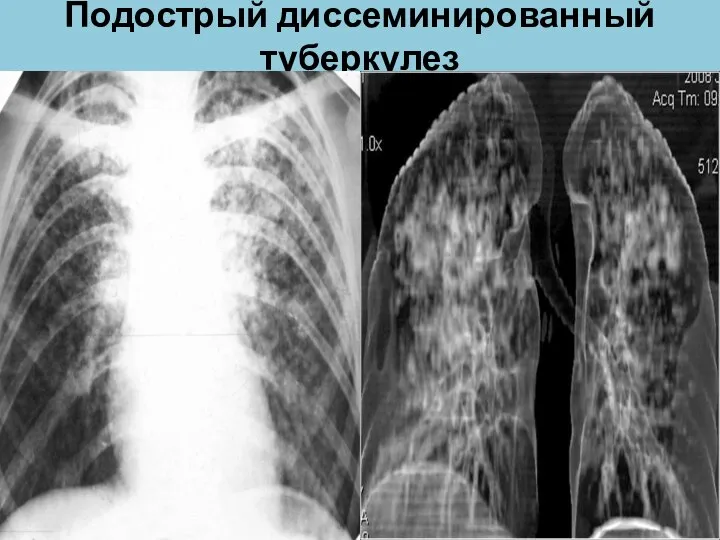 Подострый диссеминированный туберкулез