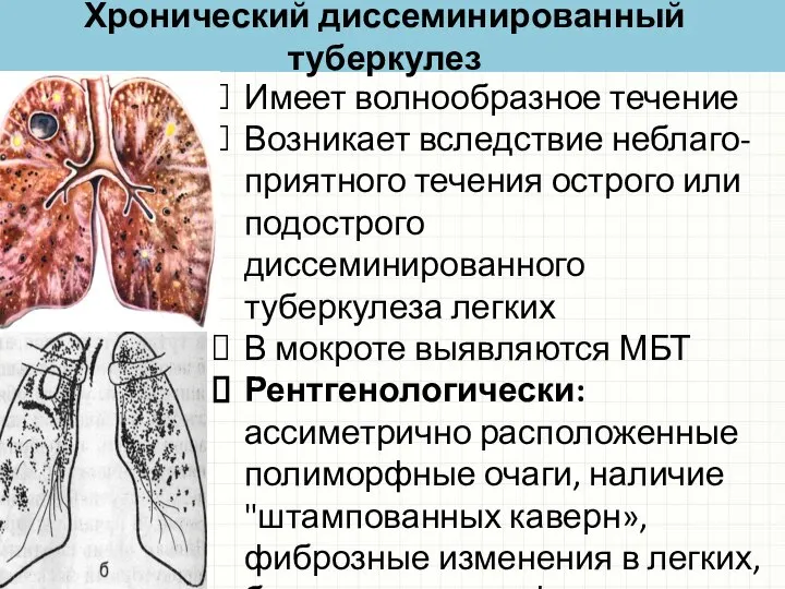 Хронический диссеминированный туберкулез Имеет волнообразное течение Возникает вследствие неблаго-приятного течения острого или