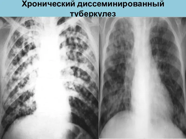 Хронический диссеминированный туберкулез