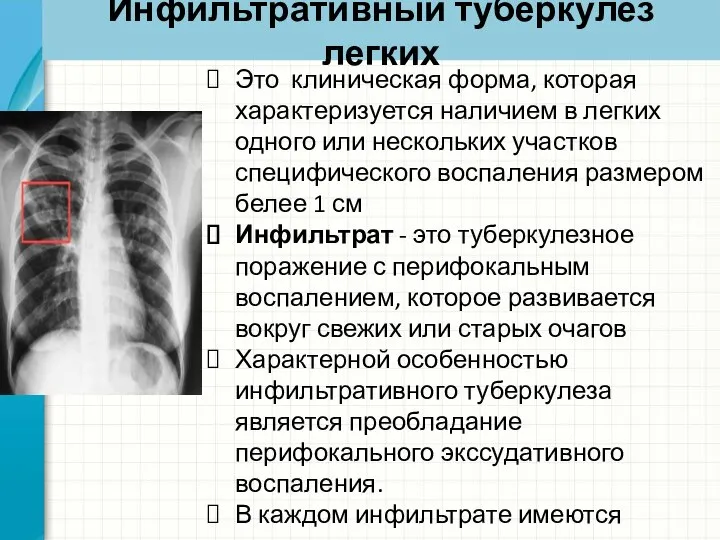 Инфильтративный туберкулез легких Это клиническая форма, которая характеризуется наличием в легких одного