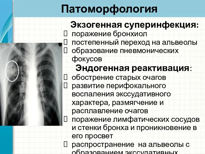 Патоморфология Экзогенная суперинфекция: поражение бронхиол постепенный переход на альвеолы образование пневмонических фокусов