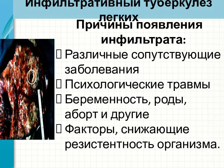 Инфильтративный туберкулез легких Причины появления инфильтрата: Различные сопутствующие заболевания Психологические травмы Беременность,