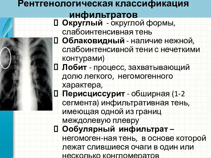 Рентгенологическая классификация инфильтратов Округлый - округлой формы, слабоинтенсивная тень Облаковидный - наличие