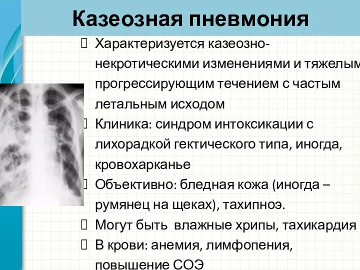 Казеозная пневмония Характеризуется казеозно-некротическими изменениями и тяжелым прогрессирующим течением с частым летальным