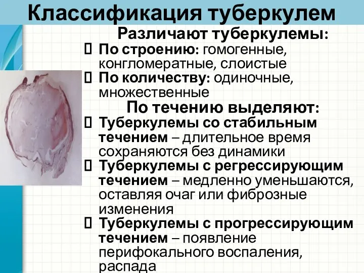 Классификация туберкулем Различают туберкулемы: По строению: гомогенные, конгломератные, слоистые По количеству: одиночные,