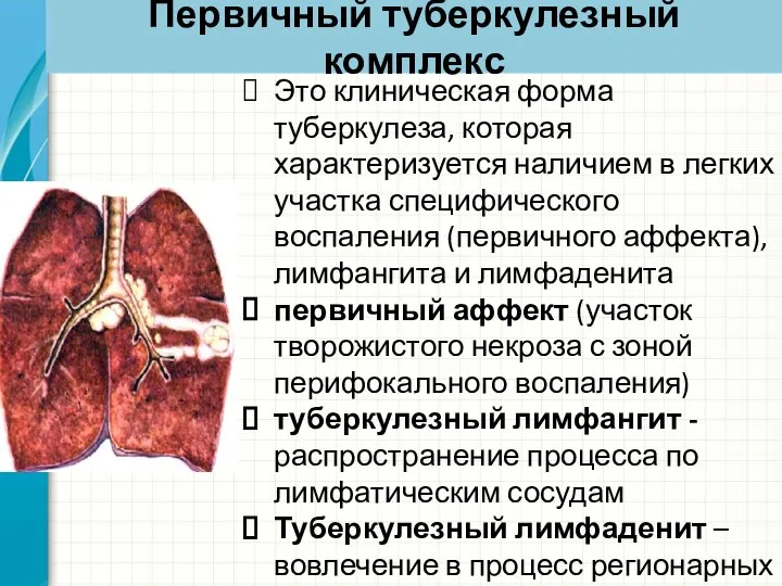 Первичный туберкулезный комплекс Это клиническая форма туберкулеза, которая характеризуется наличием в легких