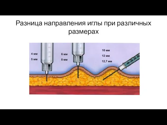 Разница направления иглы при различных размерах