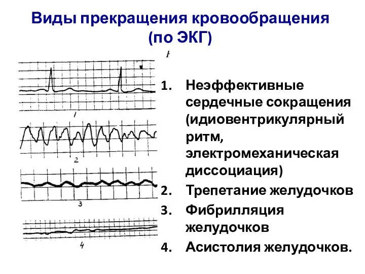 Виды прекращения кровообращения (по ЭКГ) Неэффективные сердечные сокращения (идиовентрикулярный ритм, электромеханическая диссоциация)