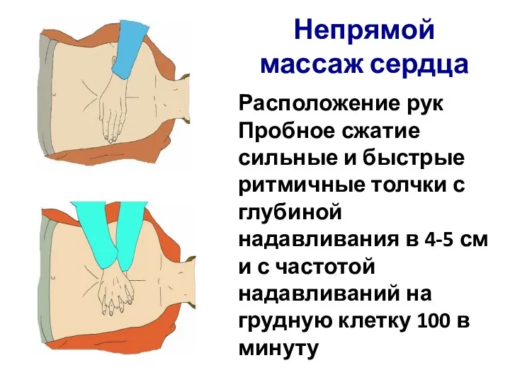 Расположение рук Пробное сжатие сильные и быстрые ритмичные толчки с глубиной надавливания