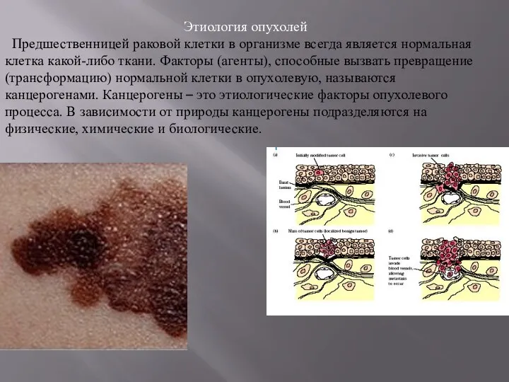 Этиология опухолей Предшественницей раковой клетки в организме всегда является нормальная клетка какой-либо