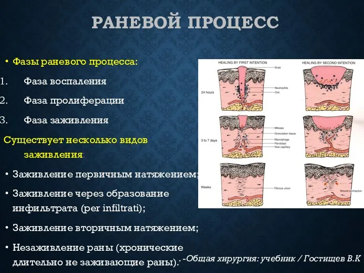 РАНЕВОЙ ПРОЦЕСС Фазы раневого процесса: Фаза воспаления Фаза пролиферации Фаза заживления Существует