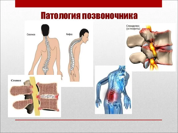 Патология позвоночника