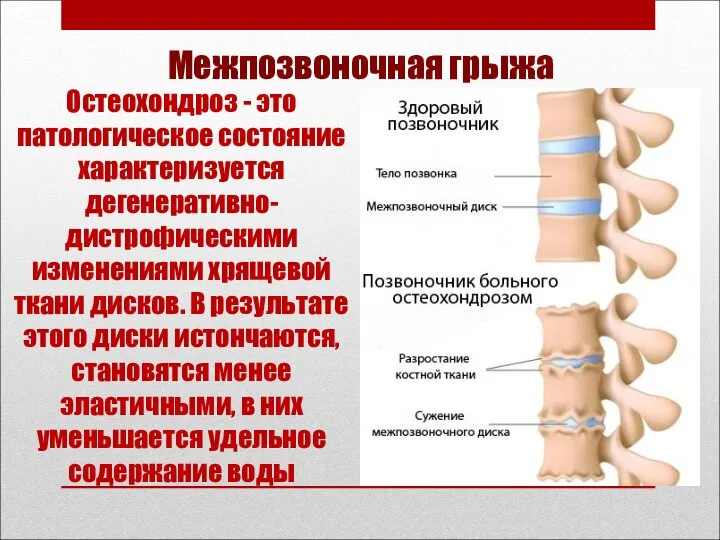 Межпозвоночная грыжа Остеохондроз - это патологическое состояние характеризуется дегенеративно-дистрофическими изменениями хрящевой ткани