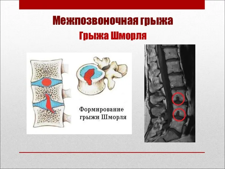 Межпозвоночная грыжа Грыжа Шморля