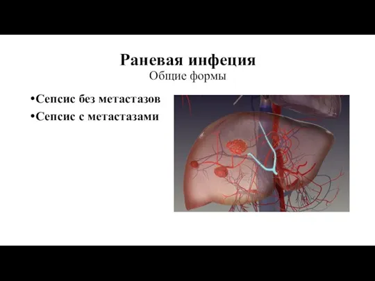 Раневая инфеция Общие формы Сепсис без метастазов Сепсис с метастазами