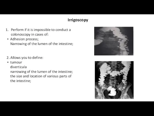 Irrigoscopy Perform if it is impossible to conduct a colonoscopy in cases